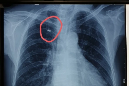 Vị trí mảnh bom trước khi gắp ra. (Ảnh: BVCC)