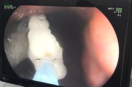 Hình ảnh nội soi thấy dị vật là răng giả trong dạ dày bệnh nhân V.T.T.