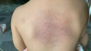 Trẻ bị bạo hành ở nhóm trẻ tư thục.