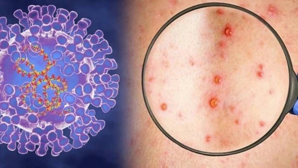 Bến Tre phát hiện ca bệnh đậu mùa khỉ đầu tiên (Ảnh minh họa).