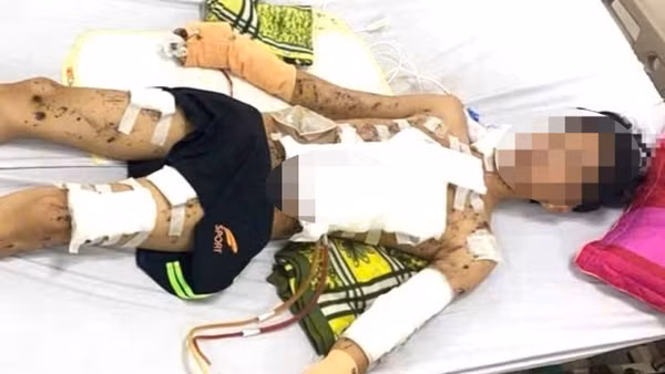 Học sinh 16 tuổi ở Quảng Bình bị thương nặng do tự chế pháo. (Ảnh: TH)