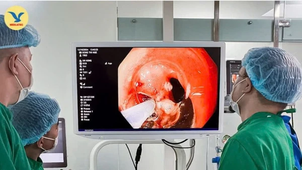 Nội soi cắt tách dưới niêm mạc (ESD) là kỹ thuật hiện đại hàng đầu thế giới trong điều trị ung thư sớm đường tiêu hóa.