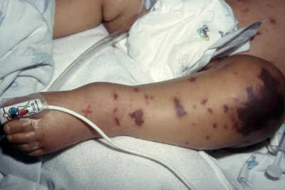 Tử ban do não mô cầu có đặc trưng là không biến mất khi dùng một vật trong suốt như ly thủy tinh ấn lên da. (Ảnh: Meningitis Research Foundation)