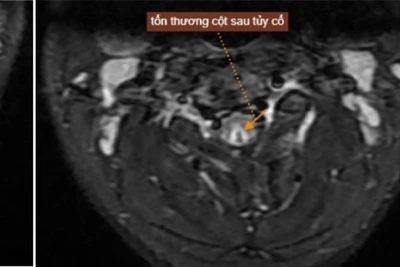 Tổn thương của nam thanh niên sau khi hút bóng cười. 