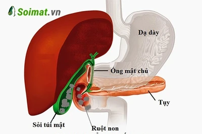 Chủ quan với sỏi túi mật, người phụ nữ bị tắc ruột