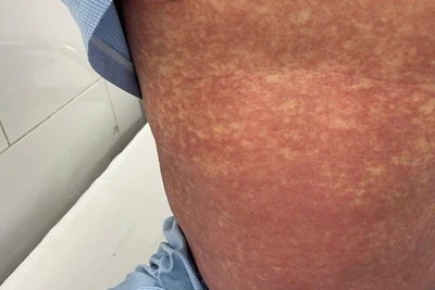 Hình ảnh phát ban toàn thân do dị ứng. 