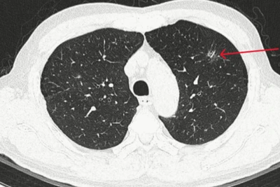 Thùy trên phổi trái có đám tổn thương kính mờ, bờ tua gai kích thước 10x13mm.