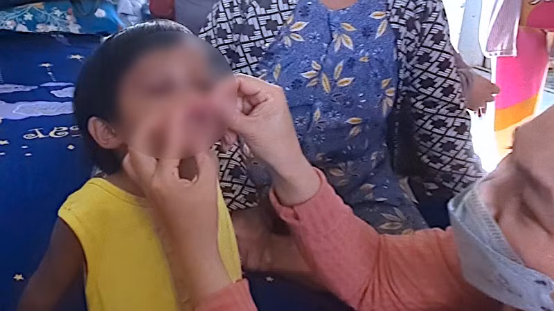 Cháu bé T.N.T (sinh năm 2020) bị nhiều vết bầm trên cơ thể, nghi ngờ bị cha nuôi đánh đập, hành hạ.