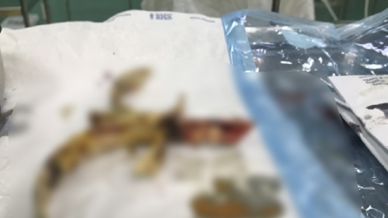Dị vật kim loại (bông cửa sắt hàng rào) cắm chặt vào hộp sọ độ sâu 4-5 cm.