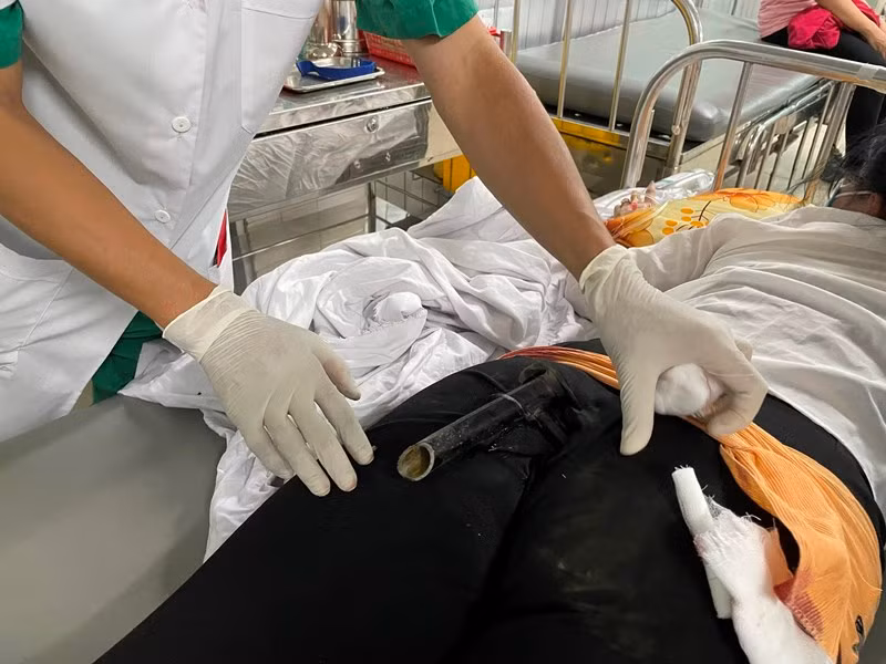 Nữ bệnh nhân N.T.Y.N. nhập viện cấp cứu với chân chống xe máy đâm dính vào mông.