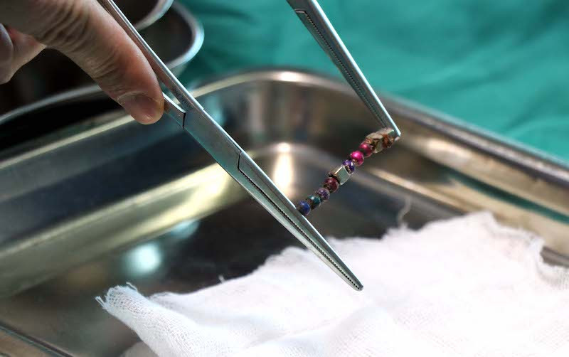 Dị vật được lấy ra trong ruột bệnh nhân. Lấy thành công nhiều dị vật có từ tính trong ruột bệnh nhi -0