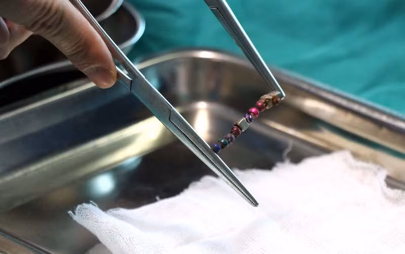 Lấy thành công nhiều dị vật có từ tính trong ruột bệnh nhi -0