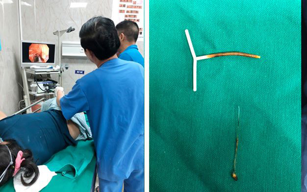 Kíp bác sĩ Khoa Nội soi tiêu hóa thực hiện gắp dị vật cho bệnh nhân N.