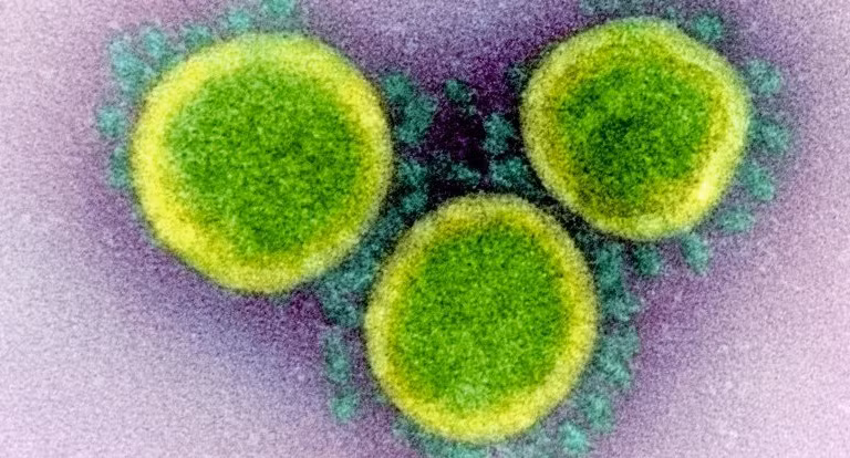Hình ảnh các hạt virus SARS-CoV-2 qua kính hiển vi điện tử. Ảnh: NIAID.