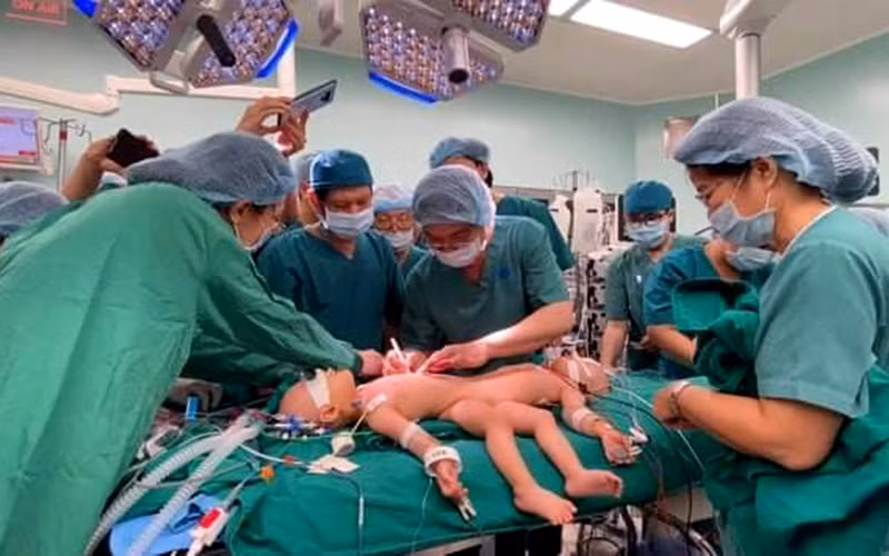 Các bác sĩ bắt đầu cuộc mổ tách dính cặp song sinh Trúc Nhi - Diệu Nhi. 