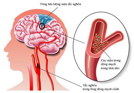 (Ảnh minh họa). Gia tăng đột quỵ não ở người trẻ, những nguyên nhân nào bị bỏ sót? -0