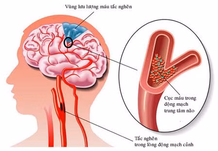 Gia tăng đột quỵ não ở người trẻ, những nguyên nhân nào bị bỏ sót? -0
