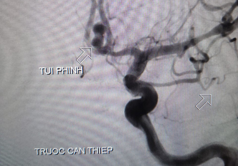 Hình ảnh túi phình mạch máu trước khi can thiệp. Cứu bệnh nhân Covid-19 vỡ túi phình mạch máu não -0