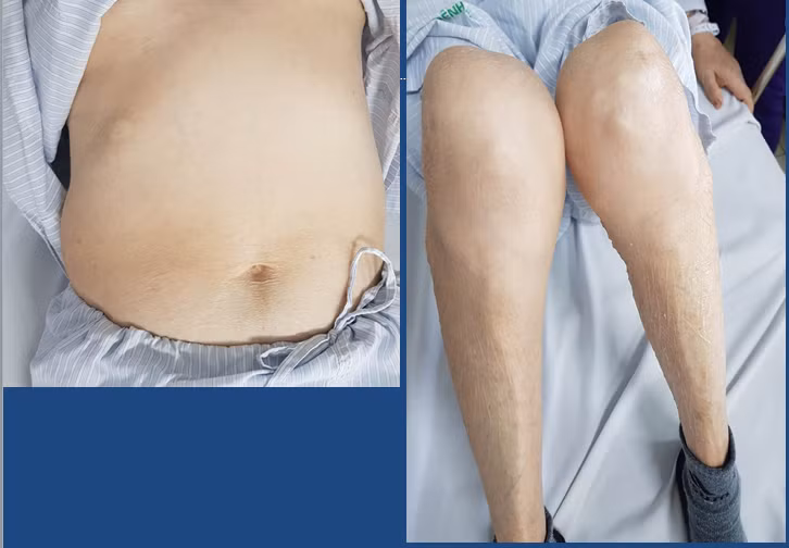 Bệnh nhân có biểu hiện kiểu hình Cushing.