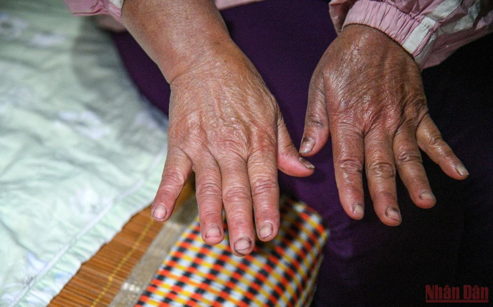 Đôi tay của chị Hiền sưng tấy, ửng đỏ vì giá rét. (ẢNH: THÀNH ĐẠT) Dân ngụ cư ven sông Hồng chống rét -0