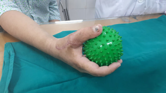Bàn tay bệnh nhân có thể cầm nắm bình thường sau ca ghép. Phẫu thuật chuyển ngón chân thành ngón tay cho thanh niên 17 tuổi -0