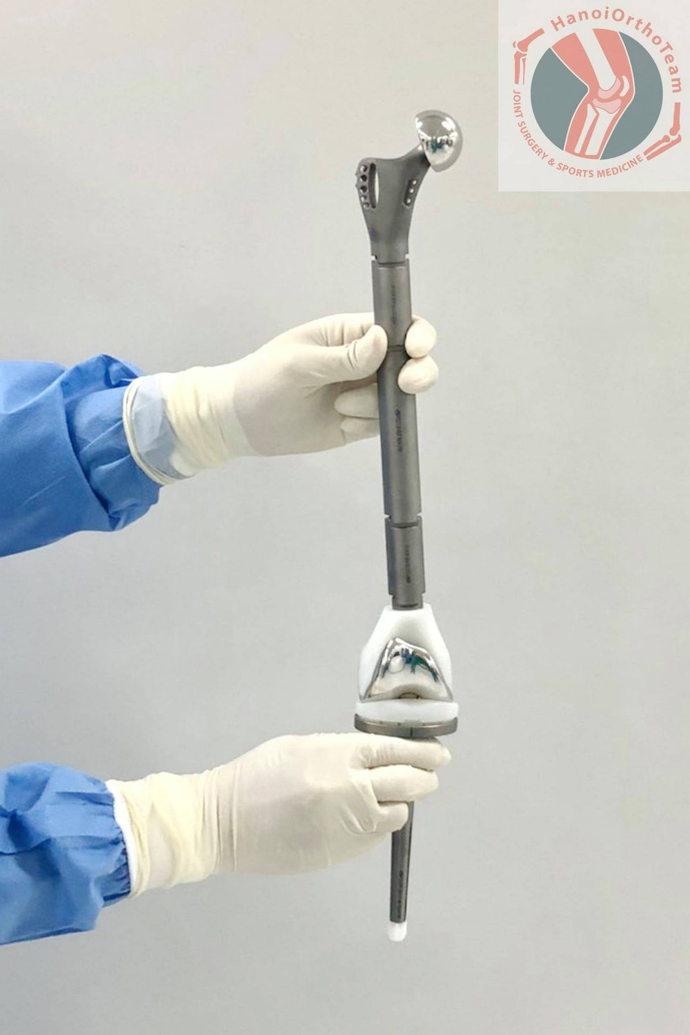 Xương đùi nhân tạo bằng hợp kim Titan được in 3D theo thông số giải phẫu của người bệnh. Kỳ tích bệnh nhi nhỏ tuổi nhất Việt Nam được thay toàn bộ xương đùi -0