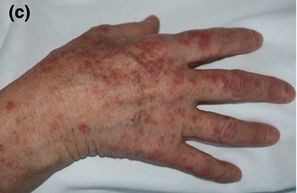 Tổn thương giống hồng ban đa dạng. Những dấu hiệu nhận biết bệnh Covid-19 qua da -0