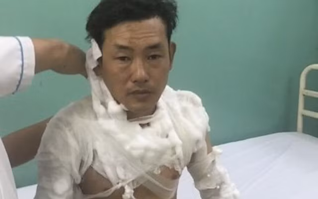 Lê Tấn Tài được can thiệp y tế khi bị bỏng.