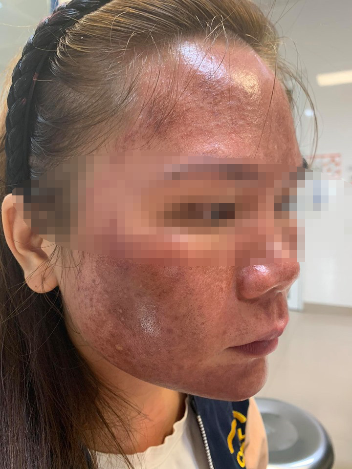 Da mặt bị cháy vì sử dụng mỹ phẩm lột da trôi nổi. Bỏng da mặt vì hóa chất từ thuốc lột da trôi nổi -0