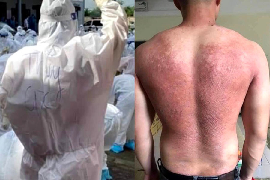 Nhiều cán bộ y tế bị phổng rộp da sau nhiều ngày mặc bộ đồ bảo hộ dưới trời nắng nóng. Thứ trưởng Nguyễn Trường Sơn: