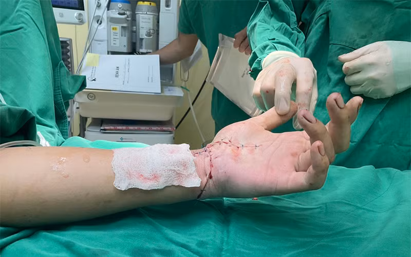 Ca bệnh có bàn tay đứt lìa được nối ghép thành công.
