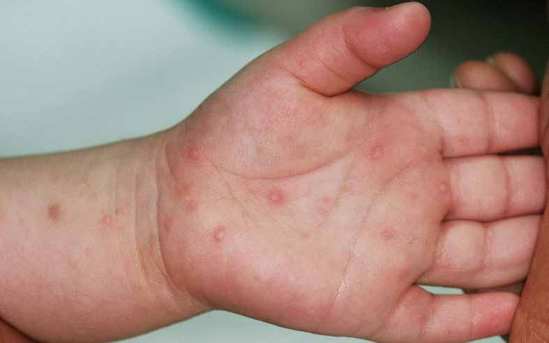 Bệnh tay chân miệng có xu hướng gia tăng