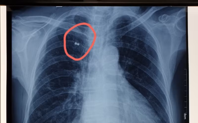 Vị trí mảnh bom trước khi gắp ra. (Ảnh: BVCC)