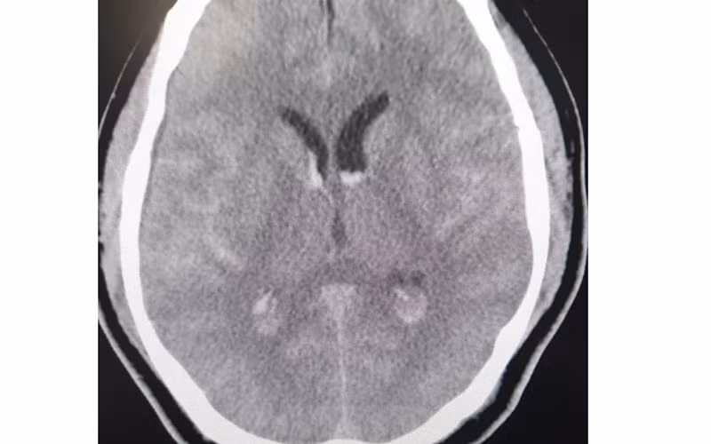 Hình ảnh phim chụp xuất huyết dưới nhện lan tỏa - tụ máu não thất.