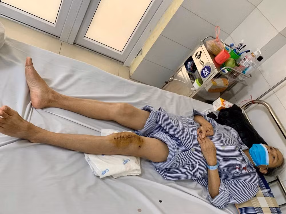 Thay khớp gối nhân tạo thành công cho người mắc lao khớp gối -0