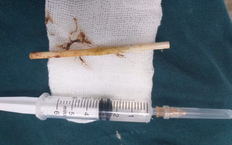 Dị vật được gắp ra trong ruột cháu bé là một que kẹo bằng nhựa dài 10 cm