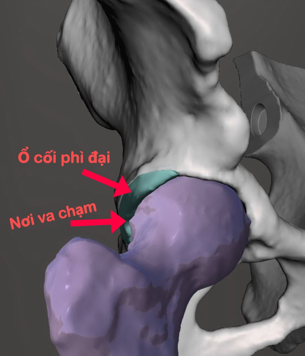 Hình ảnh 3D khớp háng bệnh nhân được mô phỏng số để các bác sĩ lên kế hoạch phẫu thuật. Lần đầu tiên, Việt Nam thực nghiệm phẫu thuật bằng công nghệ 3D -0