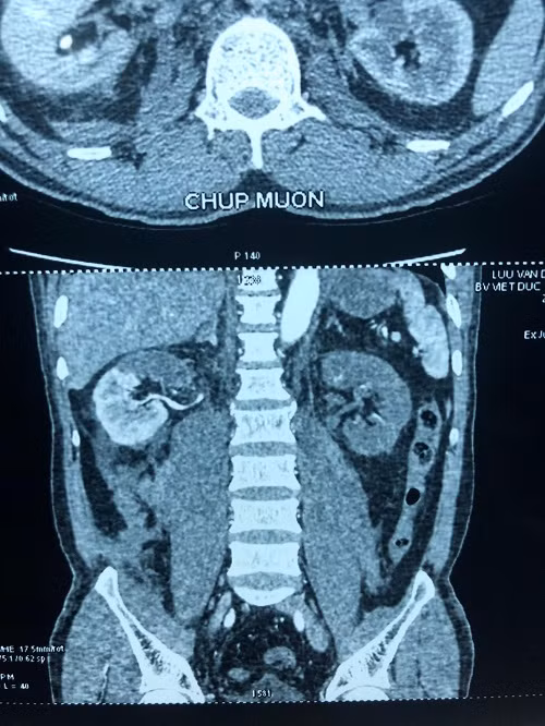 Kỳ diệu “cứu sống” quả thận bị mắc động mạch thận giờ thứ 24 -0