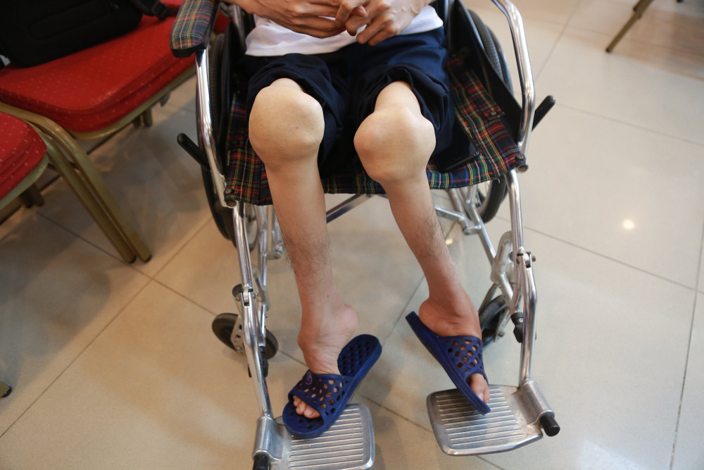 Bệnh nhân bị teo cơ vì mắc hemophilia. Điều trị dự phòng sẽ thay đổi tương lai cho người mắc bệnh hemophilia -0