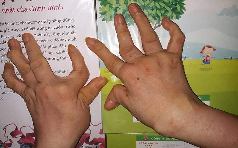 Đôi bàn tay của chị Trần Thúy Nga sau nhiều năm nhiễm bệnh viêm đa khớp. Thư viện sách miễn phí của cô gái trên chiếc xe lăn -0
