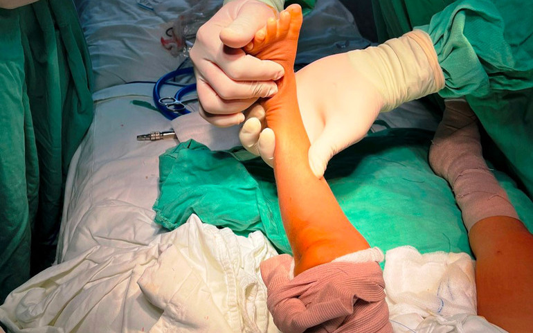 Chân của bệnh nhi sau khi được phẫu thuật. Chân của bệnh nhi sau khi được phẫu thuật.