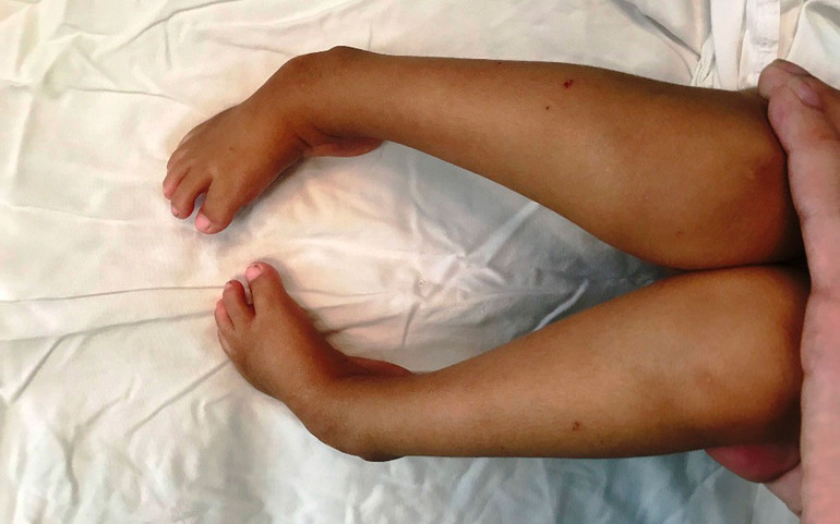 Chân của bệnh nhi bị dị tật bẩm sinh bàn chân khoèo hai bên trước khi phẫu thuật. Chân của bệnh nhi bị dị tật bẩm sinh bàn chân khoèo hai bên trước khi phẫu thuật.