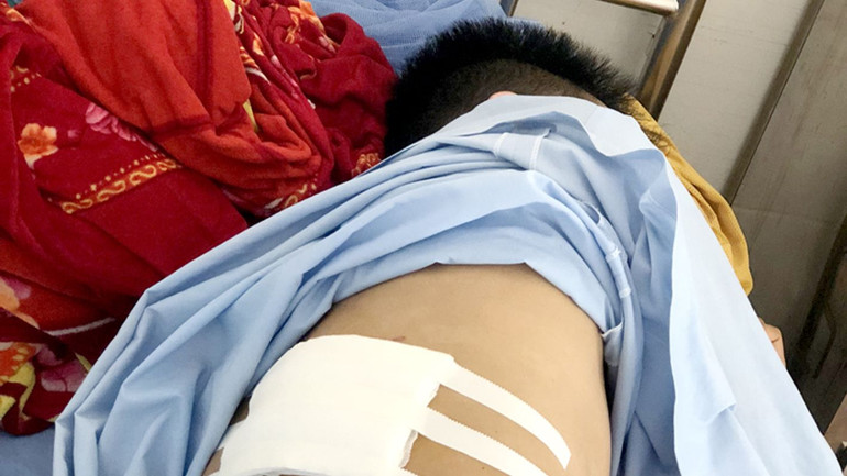 Anh L.V.N., sinh năm 1995, trú tại thôn Khuổi Xổm, xã Thượng Sơn, huyện Vị Xuyên bị chém nhập viện khi đang trên đường đi bán lá giang. Anh L.V.N., sinh năm 1995, trú tại thôn Khuổi Xổm, xã Thượng Sơn, huyện Vị Xuyên bị chém nhập viện khi đang trên đường đi bán lá giang.