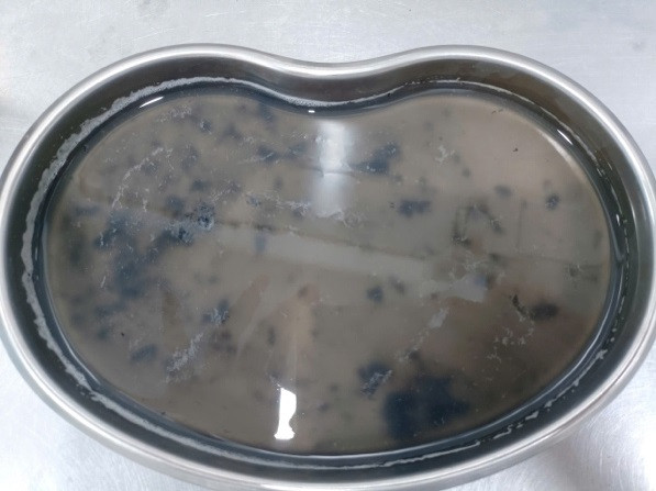 Kết quả rửa phổi, phế nang của các nạn nhân.