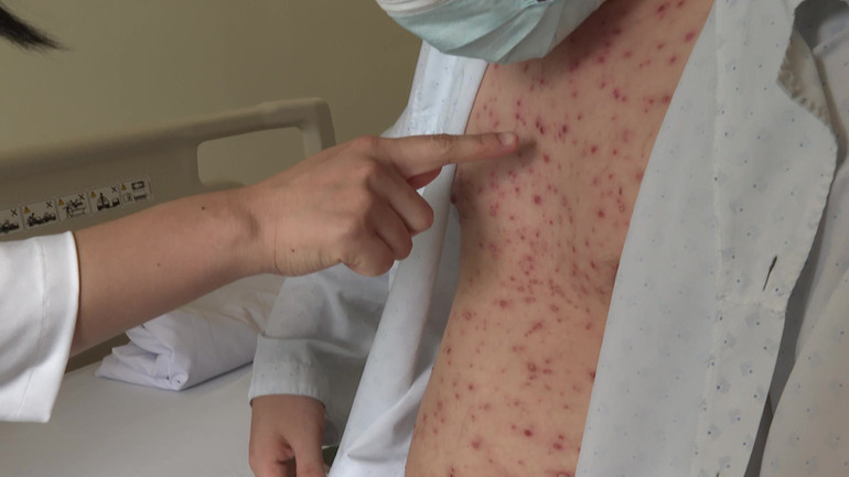 Bệnh nhân nam (34 tuổi, ngụ quận Long Biên, Hà Nội) bị biến chứng bội nhiễm da.