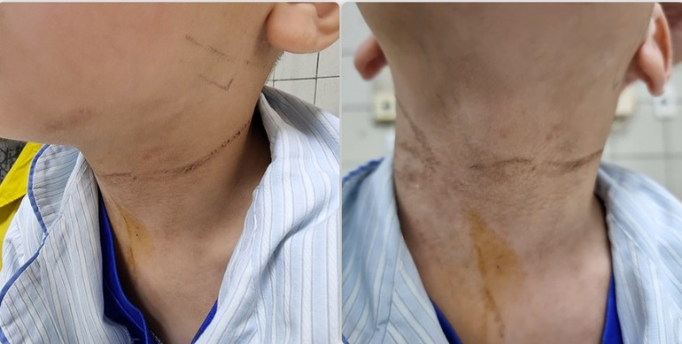 Hình ảnh vết dây thắt ở cổ bệnh nhi.