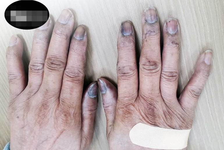 Tăng sắc tố da ở đầu ngón tay người bệnh. Tăng sắc tố da ở đầu ngón tay người bệnh.