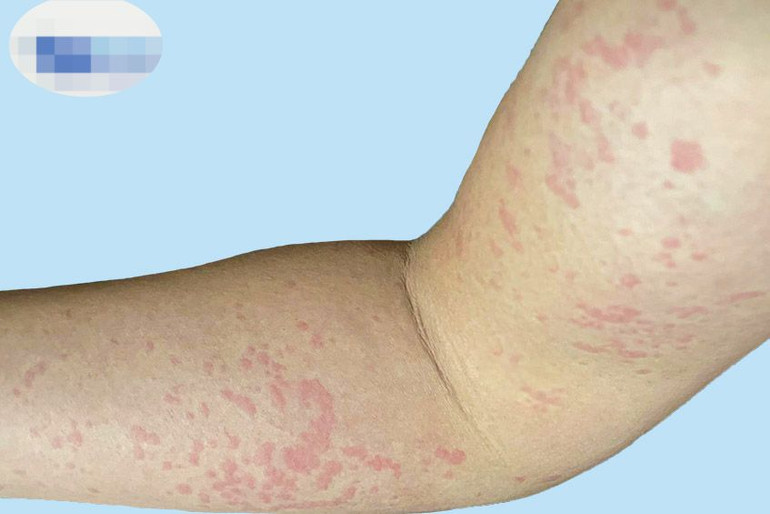 Biểu hiện của bệnh mề đay là những vết sẩn.