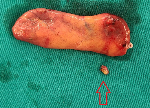 Túi mật sau khi cắt bỏ và viên sỏi nhỏ bên trong (mũi tên).