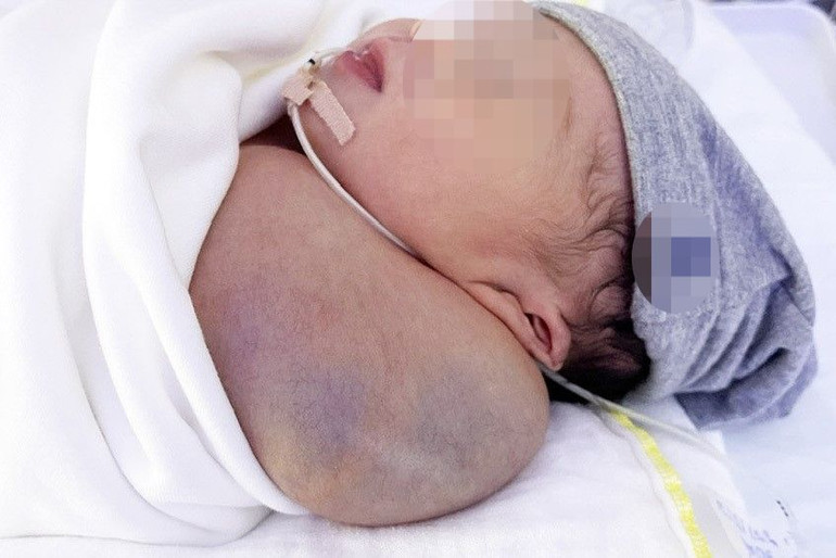 Khối u nặng bằng 1/3 trọng lượng cơ thể.